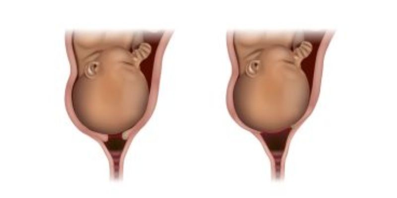 bébé dans l'utérus